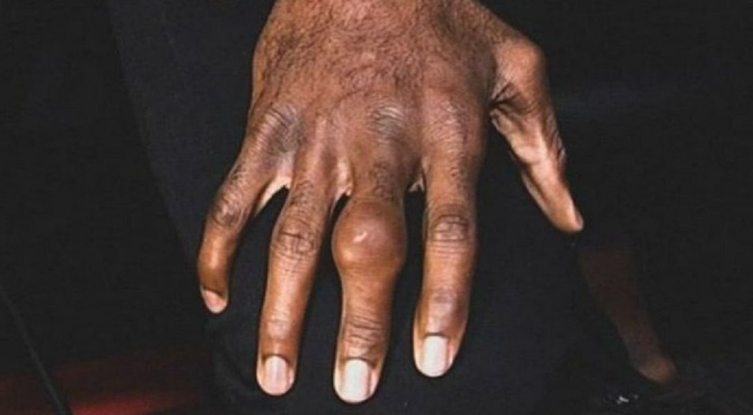 Травмированный палец Кори Андерсона